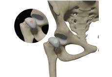 Hip Cartilage Restoration