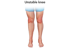 Unstable Knee